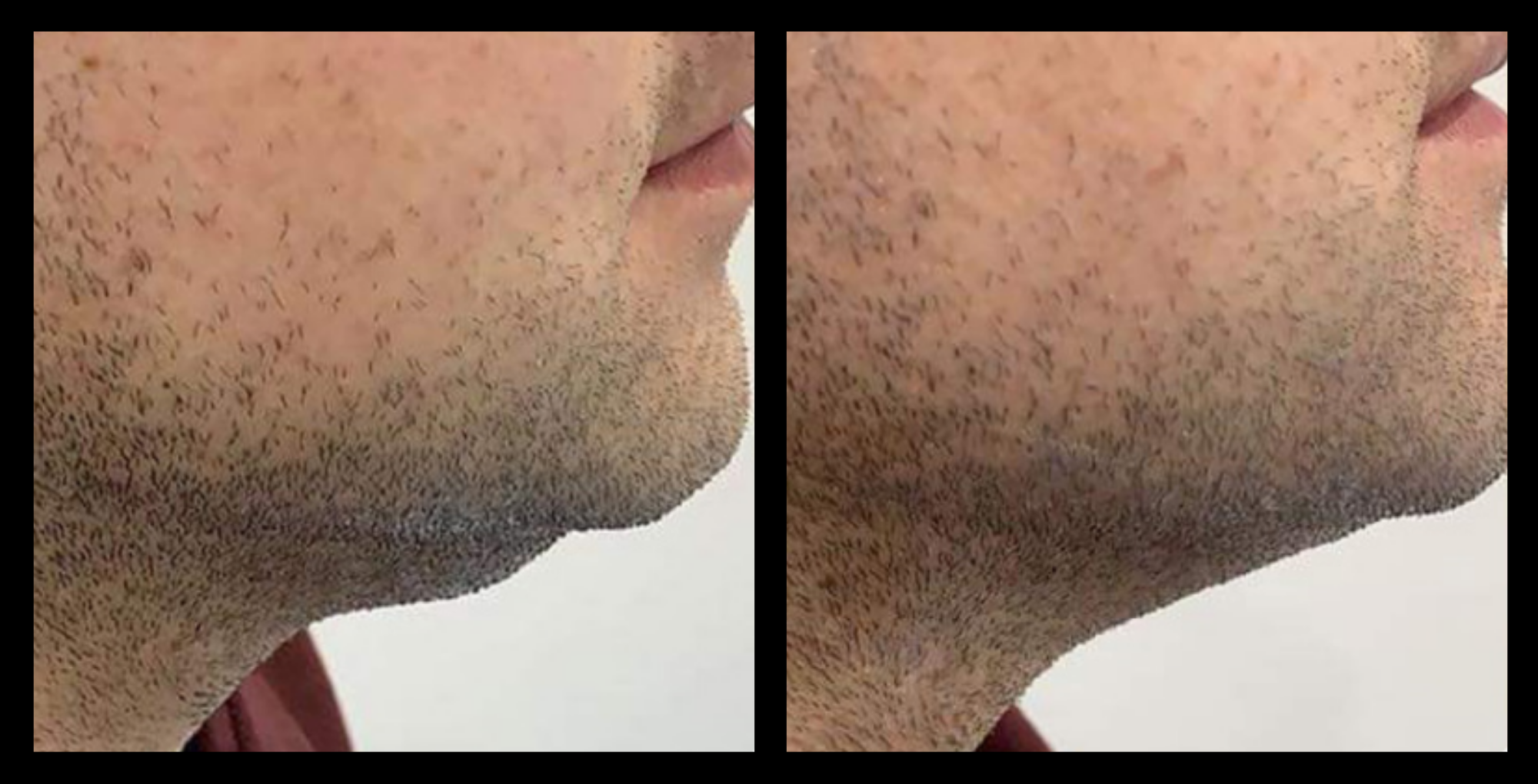 Before and after HIFU non-surgical neck lift results after 1 treatment, showing visibly firmer neck skin and improved definition. Photo courtesy of Asterasys. HIFU treatment for non-invasive neck lifting, skin tightening, and age-defying results.