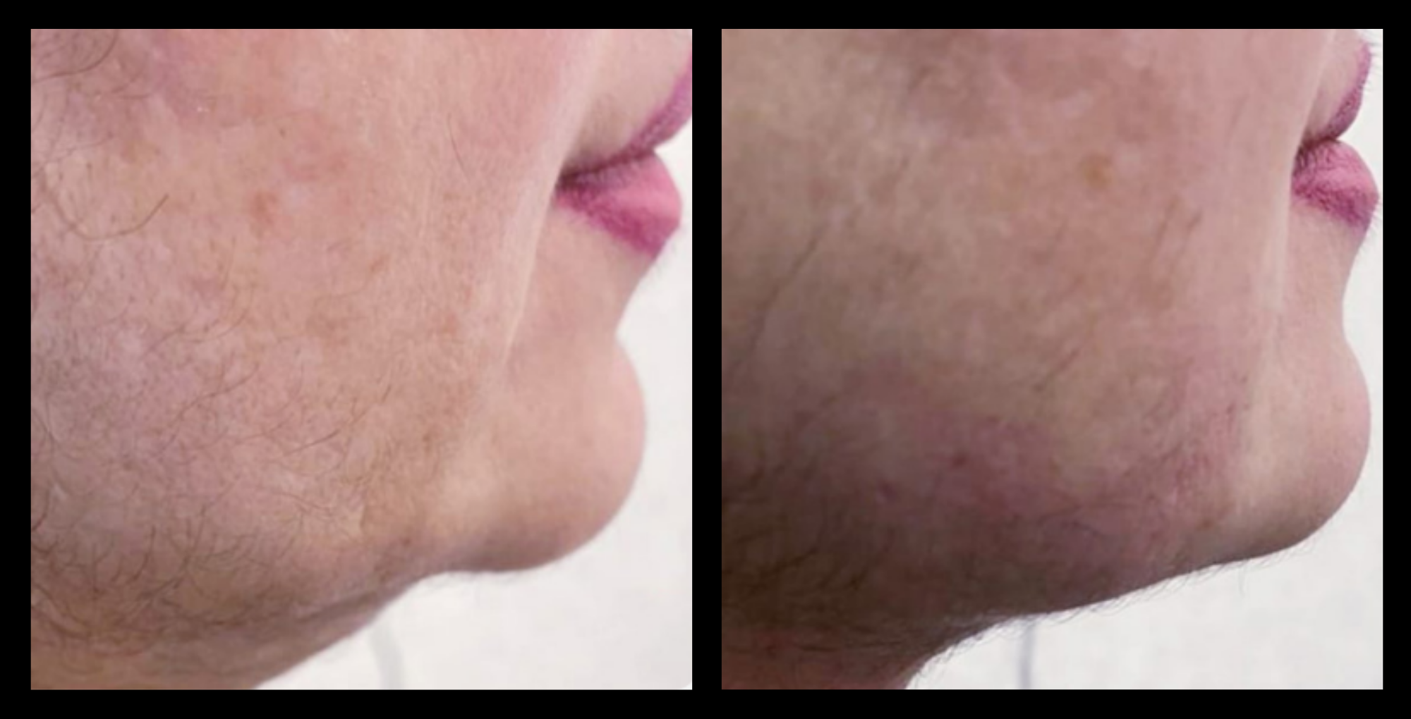 Before and after HIFU non-surgical neck lift results after 1 treatment, displaying enhanced skin firmness and reduced sagging in the neck area. Photo courtesy of Asterasys. Non-invasive HIFU neck lift for skin tightening, contour improvement, and rejuvenation.