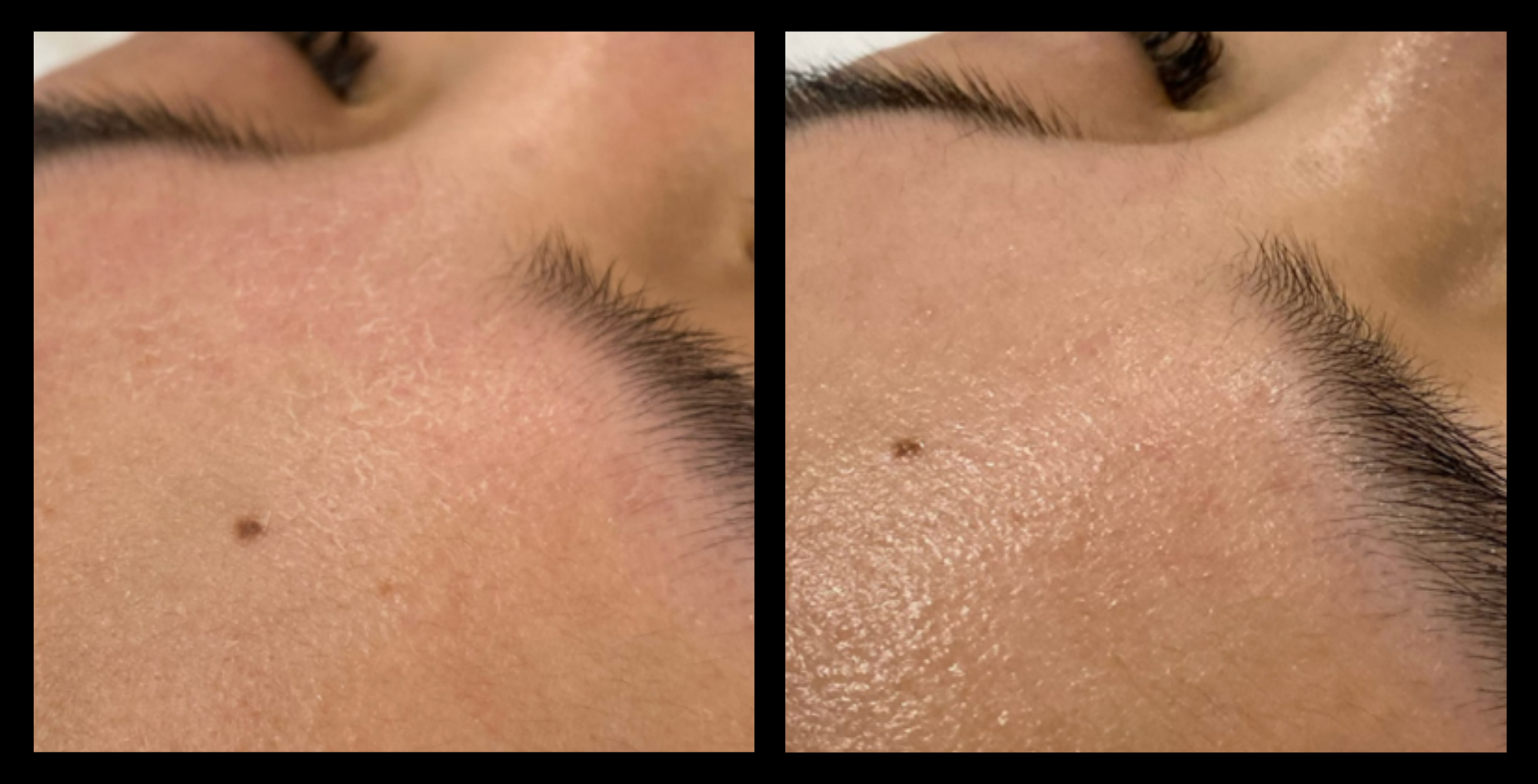 Hydro microdermabrasion machine before and after results after 1 treatment at Ritual Skin Clinic in Canley Heights, NSW, showing visibly clearer pores, refined texture, and improved skin radiance.