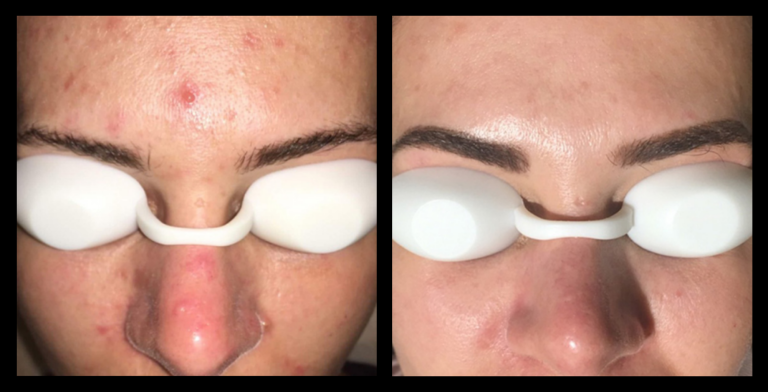 IPL acne treatment before and after results after 3 sessions at Glow Skin + Body, Doveton VIC – visible reduction in acne, redness, and inflammation for clearer skin.