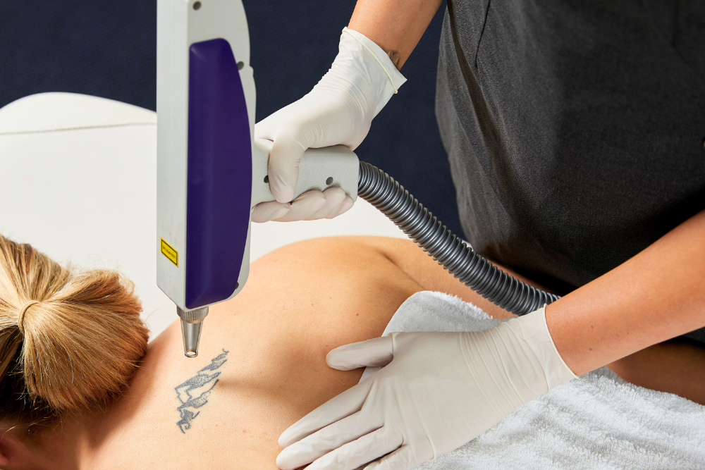 Laser tattoo removal using a professional IPL laser machine in clinic setting
