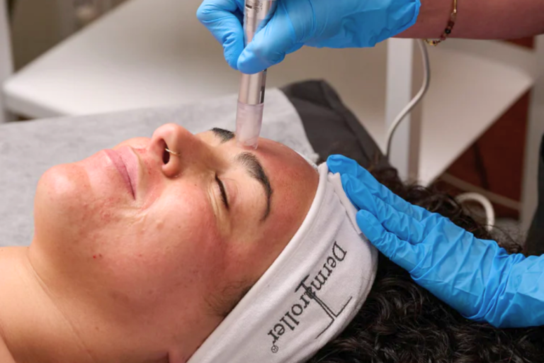 XCELLARIS PRO TWIST - MICRONEEDLING DEVICE TREATMENT FOR SKIN REJUVENATION ANS RESURFACING
