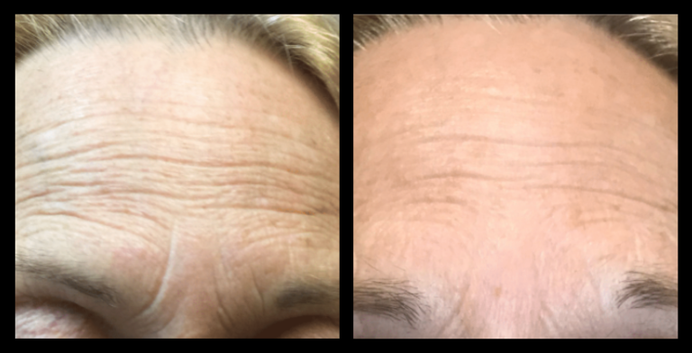 IPL photo rejuvenation before and after results after 6 treatments at The Wax Room, Manoora QLD – improved skin tone, reduced pigmentation, and revitalised complexion.