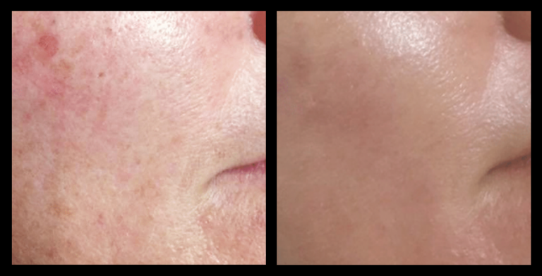 IPL Photo Rejuvenation before and after results after 2 treatments at Boutique of Cosmetic Dermatology, Varsity Lakes QLD – improved skin tone, reduced pigmentation, and clearer complexion.