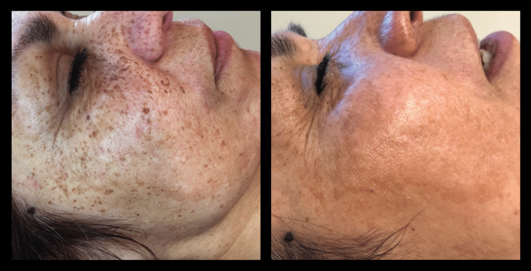 IPL pigmentation correction before and after results after 3 treatments at Glow Skin + Body, Doveton VIC – visible reduction in sunspots, age spots, and uneven skin tone.