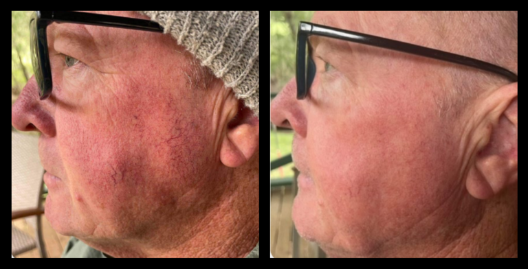 Before and after IPL vascular therapy results after 3 treatments, visibly reducing facial redness and broken capillaries. Photo courtesy of Skin and Beauty Woodlands, Woodlands WA. Non-invasive IPL treatment for clearer, even-toned skin.