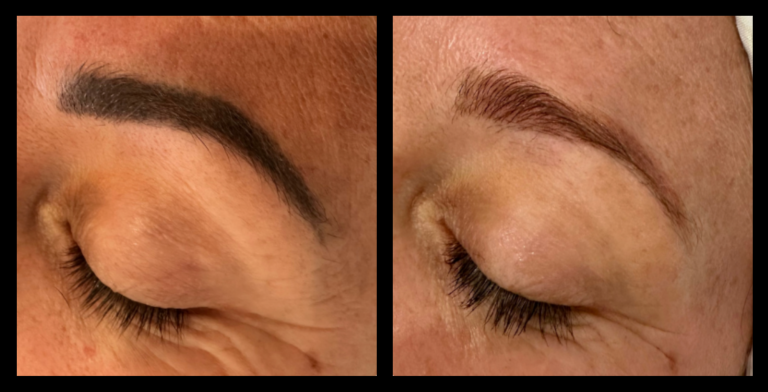 IPL Laser machine tattoo removal before and after results after 1 treatment showing visible fading – Berry Beauty Co, Ashburton, New Zealand.