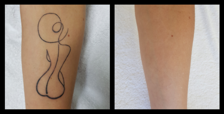 IPL Laser machine tattoo removal before and after results after 7 treatments showing advanced ink reduction – Da Vinci Skin Clinic, Bairnsdale, VIC.