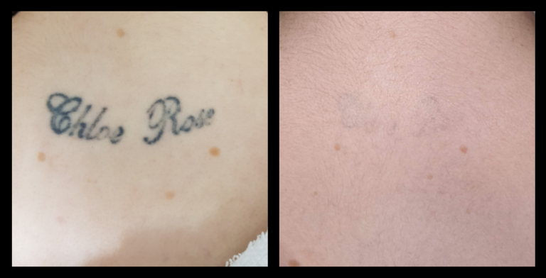 IPL Laser machine IPL machine tattoo removal results after 6 treatments showing visible ink fading – Da Vinci Skin Clinic, Bairnsdale, VIC.