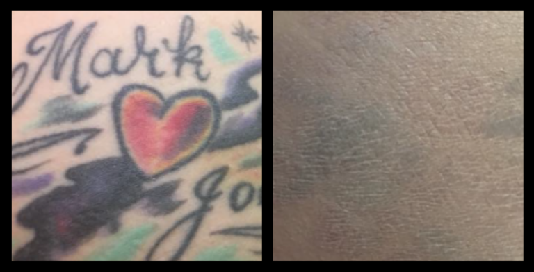 IPL Laser machine tattoo removal before and after 7 treatments – significant fading of ink by Queensland Tattoo Removal, Wurtulla, QLD.