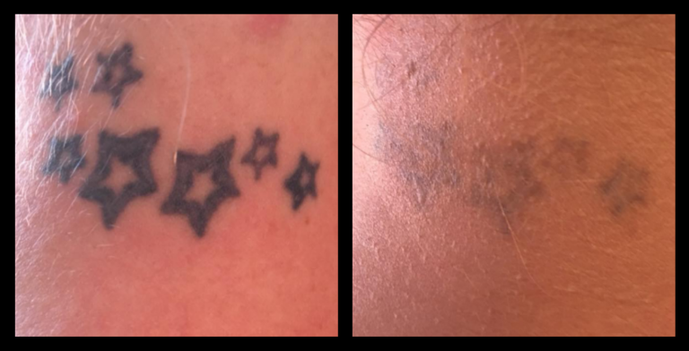 IPL Laser machine tattoo removal results after 4 treatments – visible ink reduction by Queensland Tattoo Removal, Wurtulla QLD, using professional laser technology.