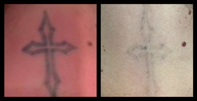 Laser tattoo removal results after 2 treatments – noticeable fading of tattoo ink by Just A Little Prick Piercing, Wollert VIC, using advanced laser technology.
