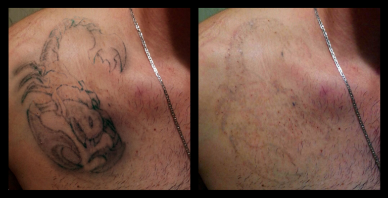 Before and after laser tattoo removal results after 5 treatments, showing significant fading of tattoo ink. Photo courtesy of St Georges Basin Hair & Beauty, Shoalhaven Heads NSW. Effective laser tattoo removal treatment for clear skin restoration.