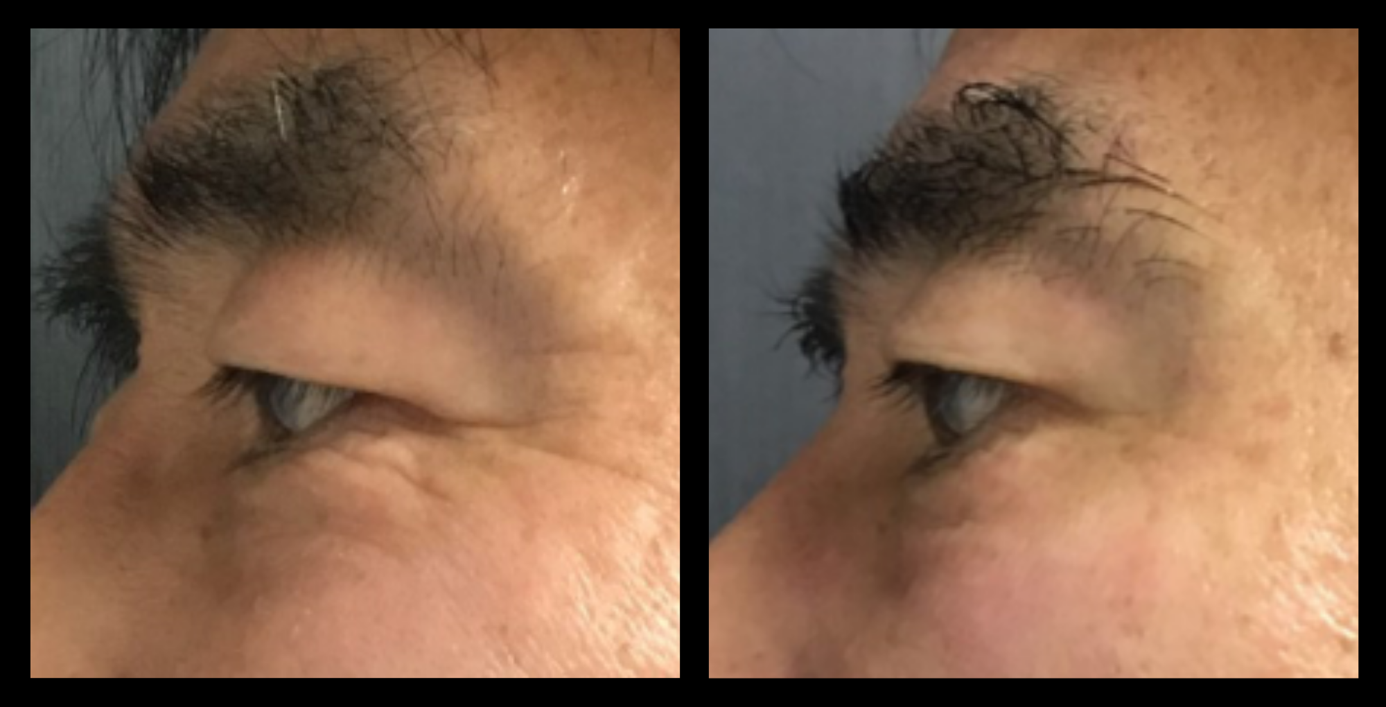 Liftera HIFU face lifting results after 1 treatment – non-invasive skin tightening and contouring. Photo courtesy of Asterasys.