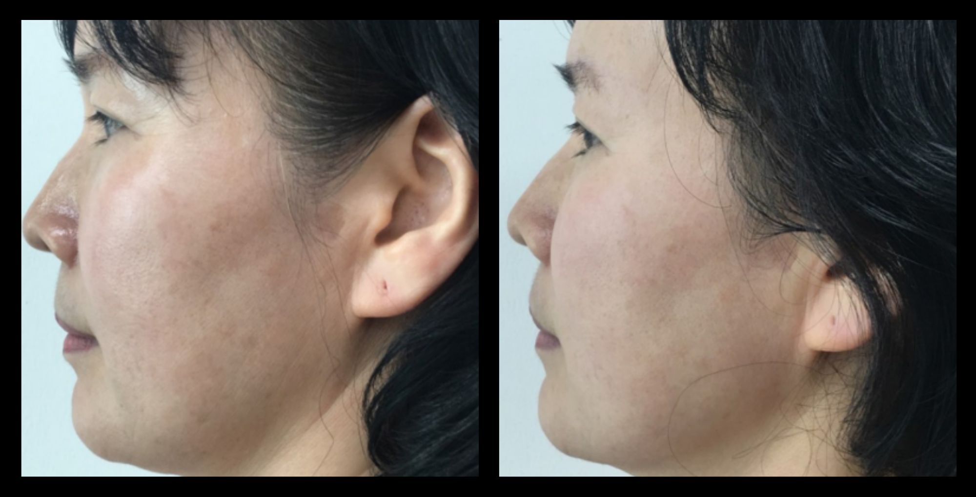 Liftera ultrasound face lift results after 1 treatment – visible skin tightening and lifting effect. Photo courtesy of Asterasys.