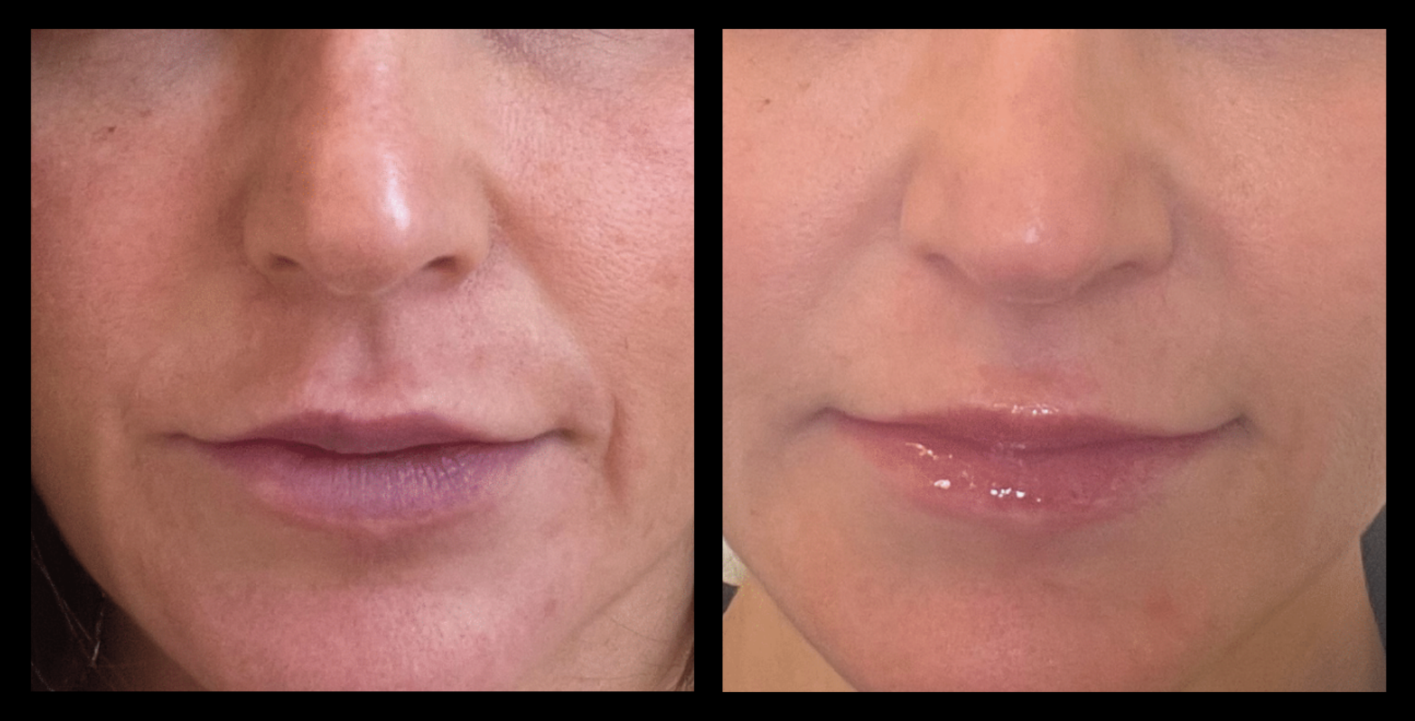Before and after image showing visible reduction in smile lines after one skin resurfacing and lifting treatment. Improved skin texture and firmness around the mouth area. Photo courtesy of Youthful by Rosie, Brighton, VIC.