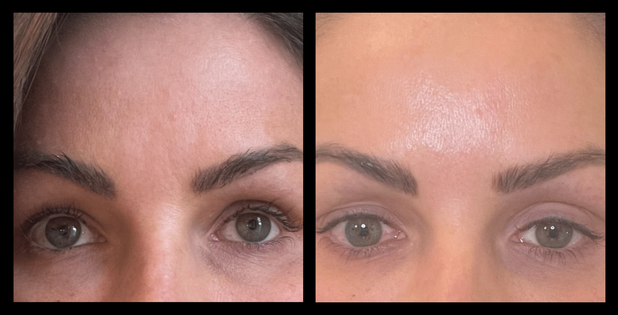 Before and after photo highlighting under-eye improvement after one skin resurfacing and lifting treatment. Noticeable reduction in fine lines and puffiness under the eyes. Photo courtesy of Youthful by Rosie, Brighton, VIC.