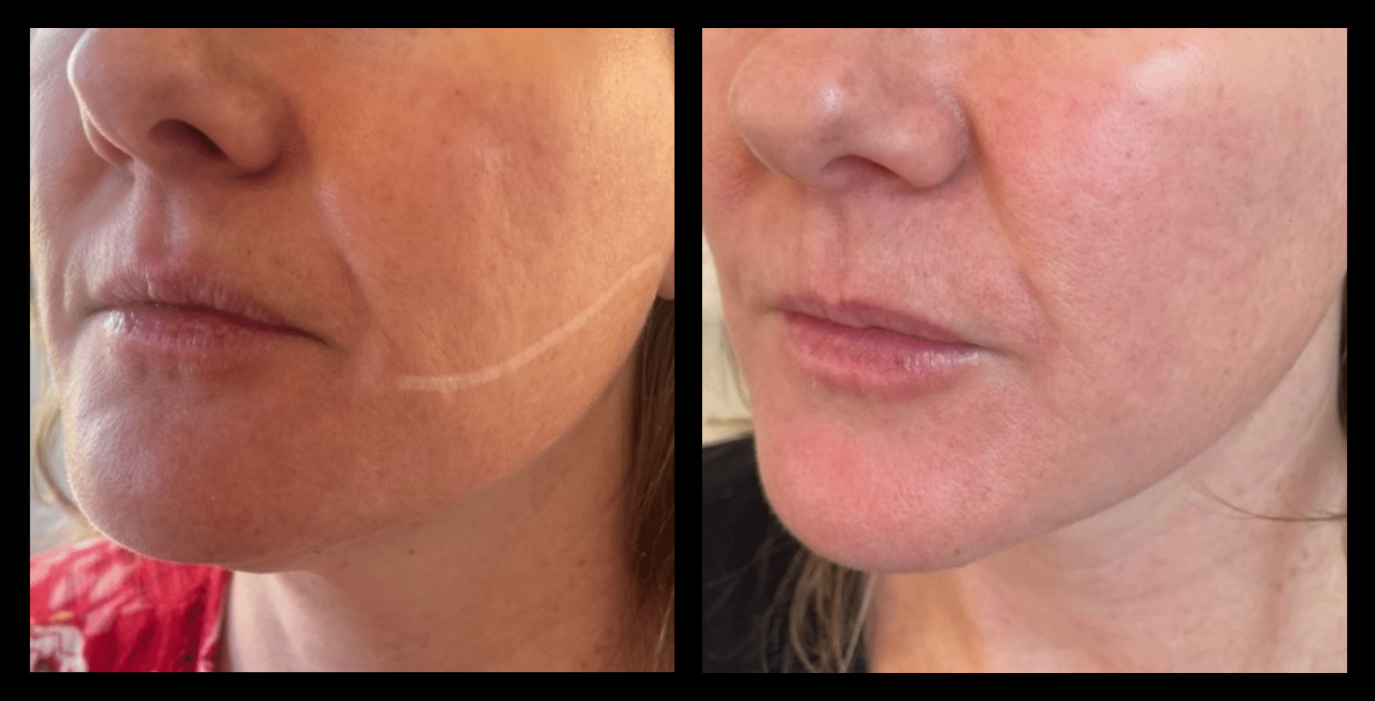 Before and after skin retraction and neocollagenesis treatment on the face showing improved firmness, reduced sagging, and enhanced skin texture after 6 sessions. Photo courtesy of Youthful by Rosie, Brighton, VIC.