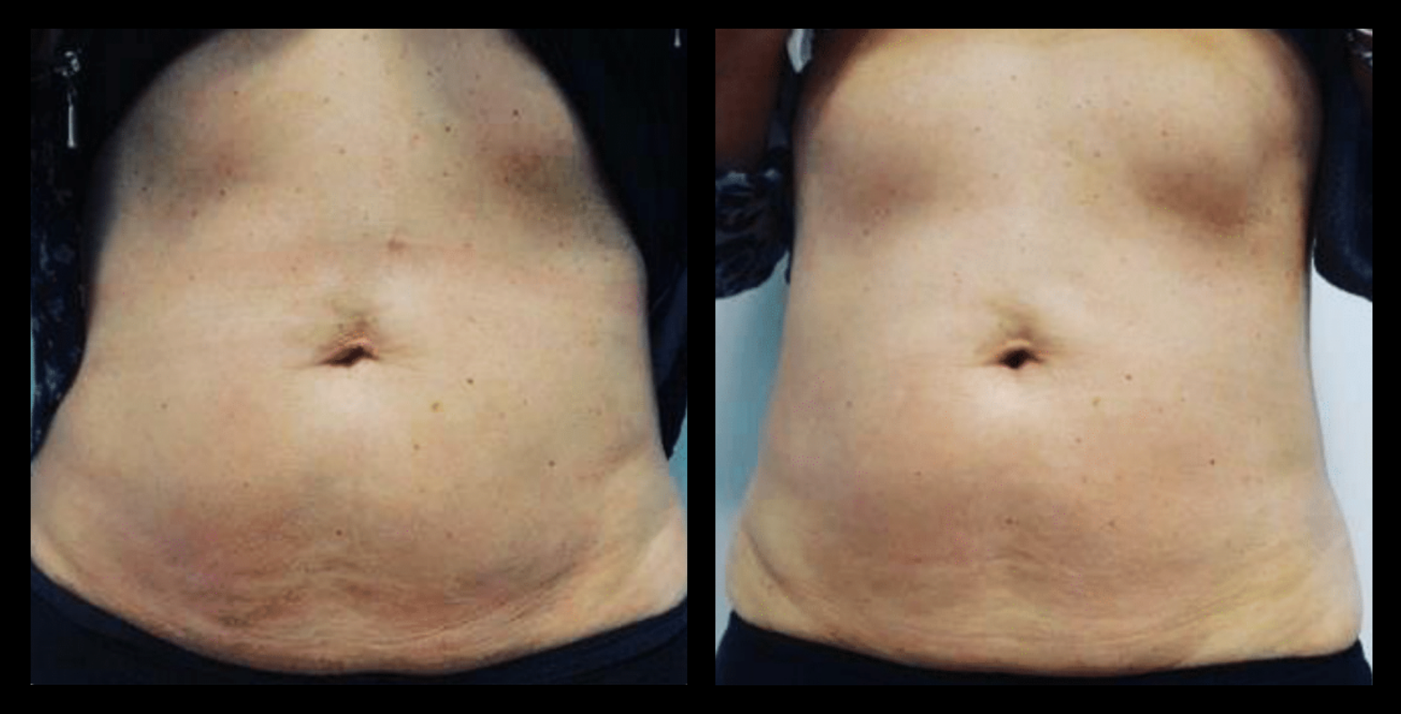 Visible skin tightening and wrinkle reduction after 2 Thuzzle Tetrawave treatments – before and after results by GMV, Italy.