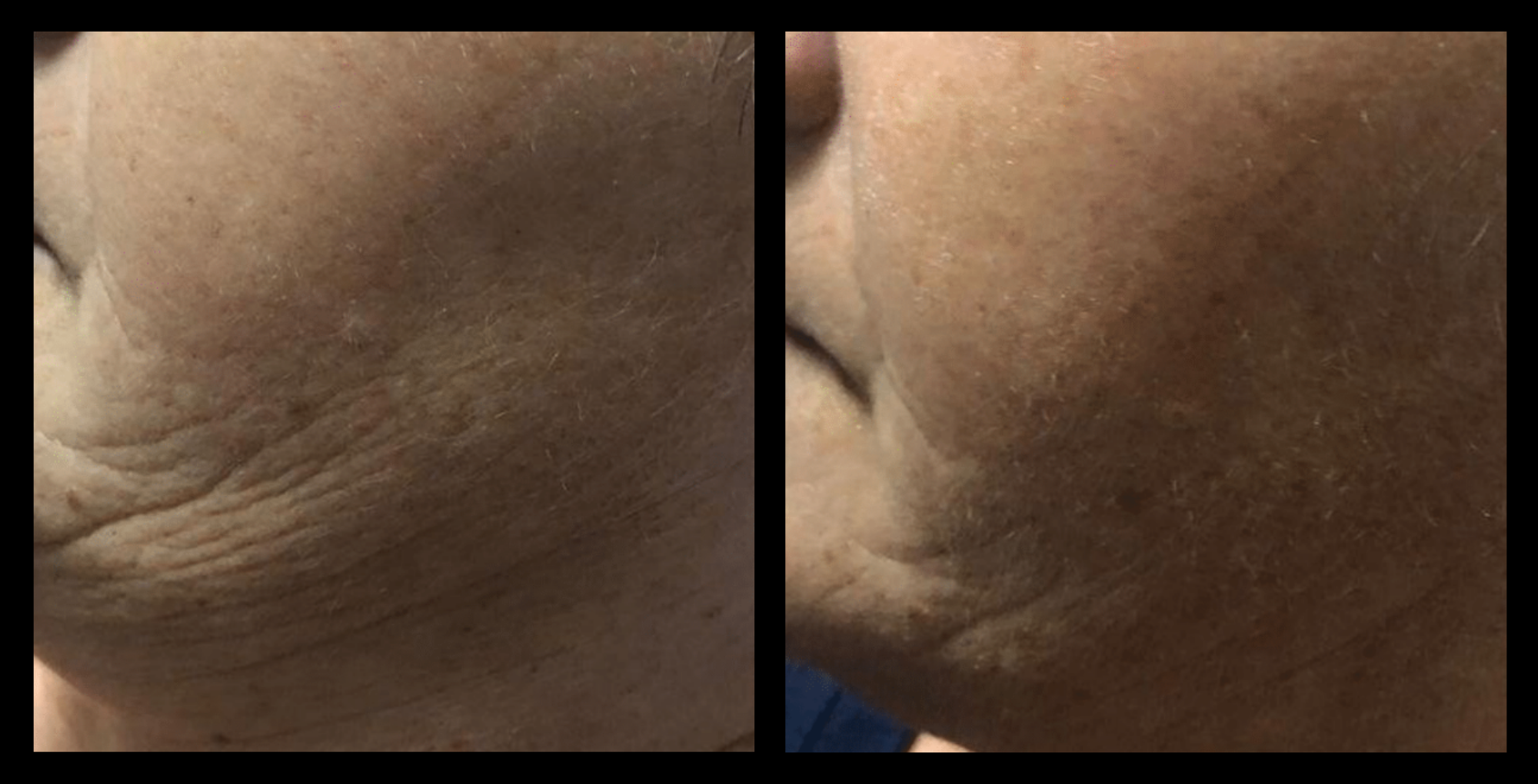 Before and after results of Thuzzle Tetrawave treatment for sagging facial skin. Noticeable skin tightening and lifting effect in the lower face and jawline area. Image courtesy of GMV. Ideal for non-surgical facial rejuvenation and collagen stimulation.