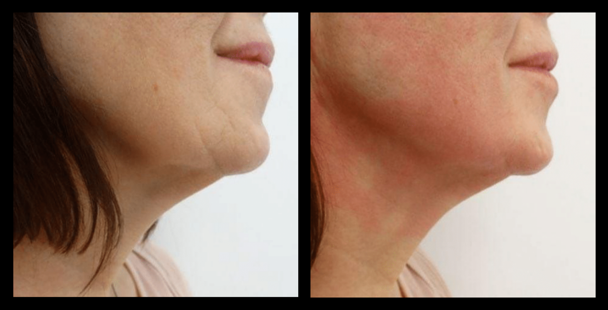 Before and after results of Thuzzle Tetrawave treatment targeting double chin reduction. Visible improvement in jawline contour and skin firmness. Image courtesy of GMV. Ideal for non-invasive fat reduction and skin tightening under the chin.