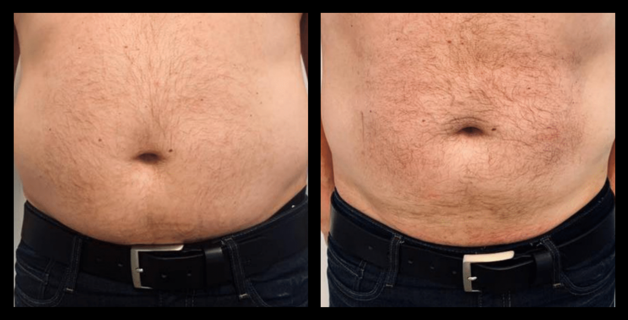 Visible under-eye tightening and wrinkle reduction after 1 Thuzzle Tetrawave treatment – before and after results by GMV, Italy.