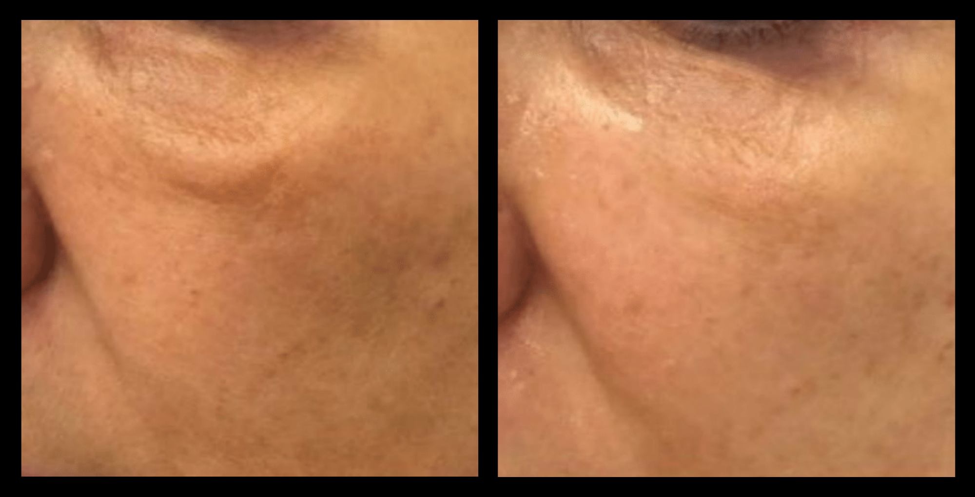 Before and after Thuzzle Tetrawave treatment targeting sagging under-eye skin. Visible improvement in skin firmness and reduction of under-eye puffiness. Image courtesy of GMV. Effective non-invasive solution for under-eye rejuvenation and collagen boosting.