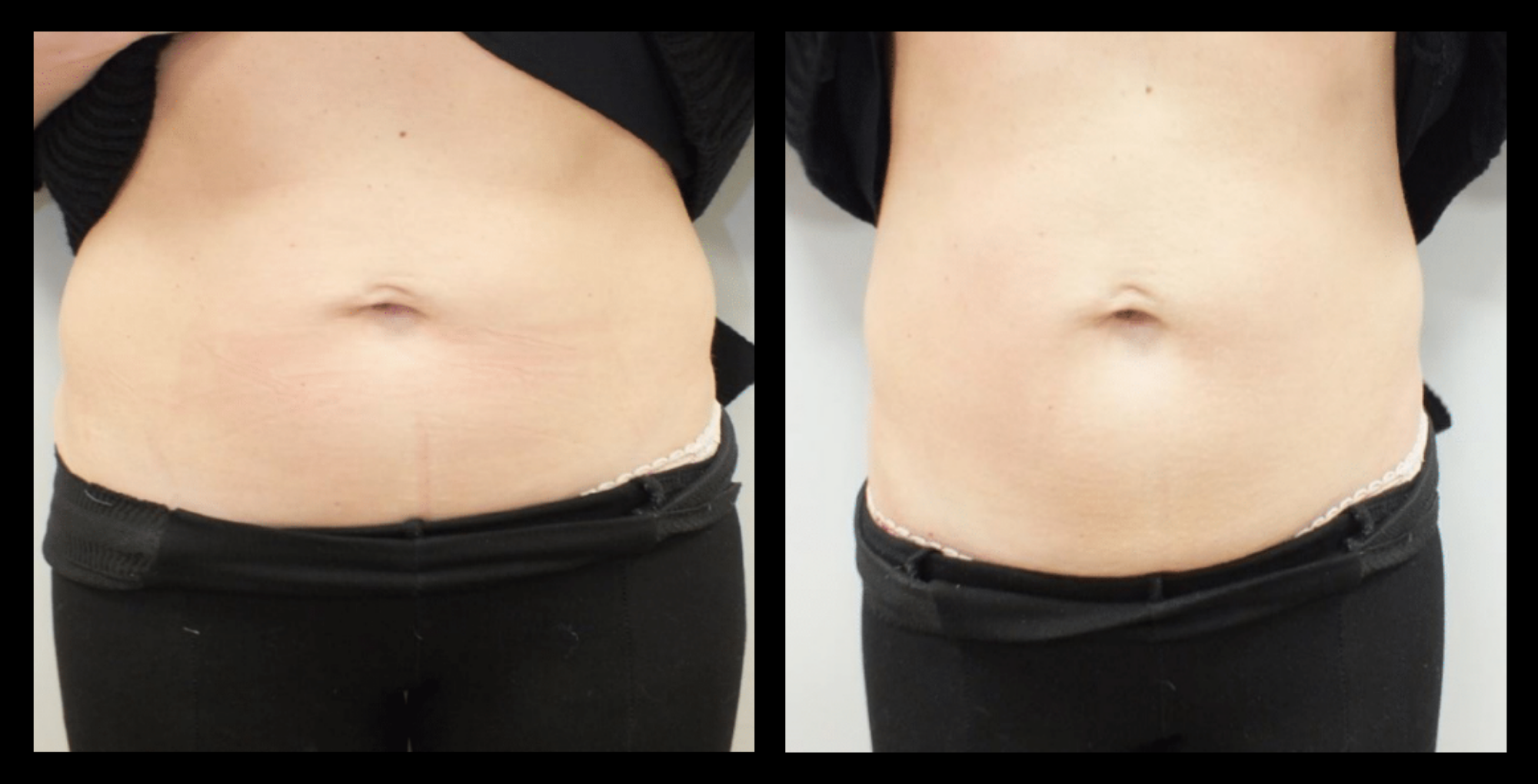 Before and after results showing reduced under-eye bags and softened smile lines after 4 Thuzzle Tetrawave treatments by GMV, Italy.