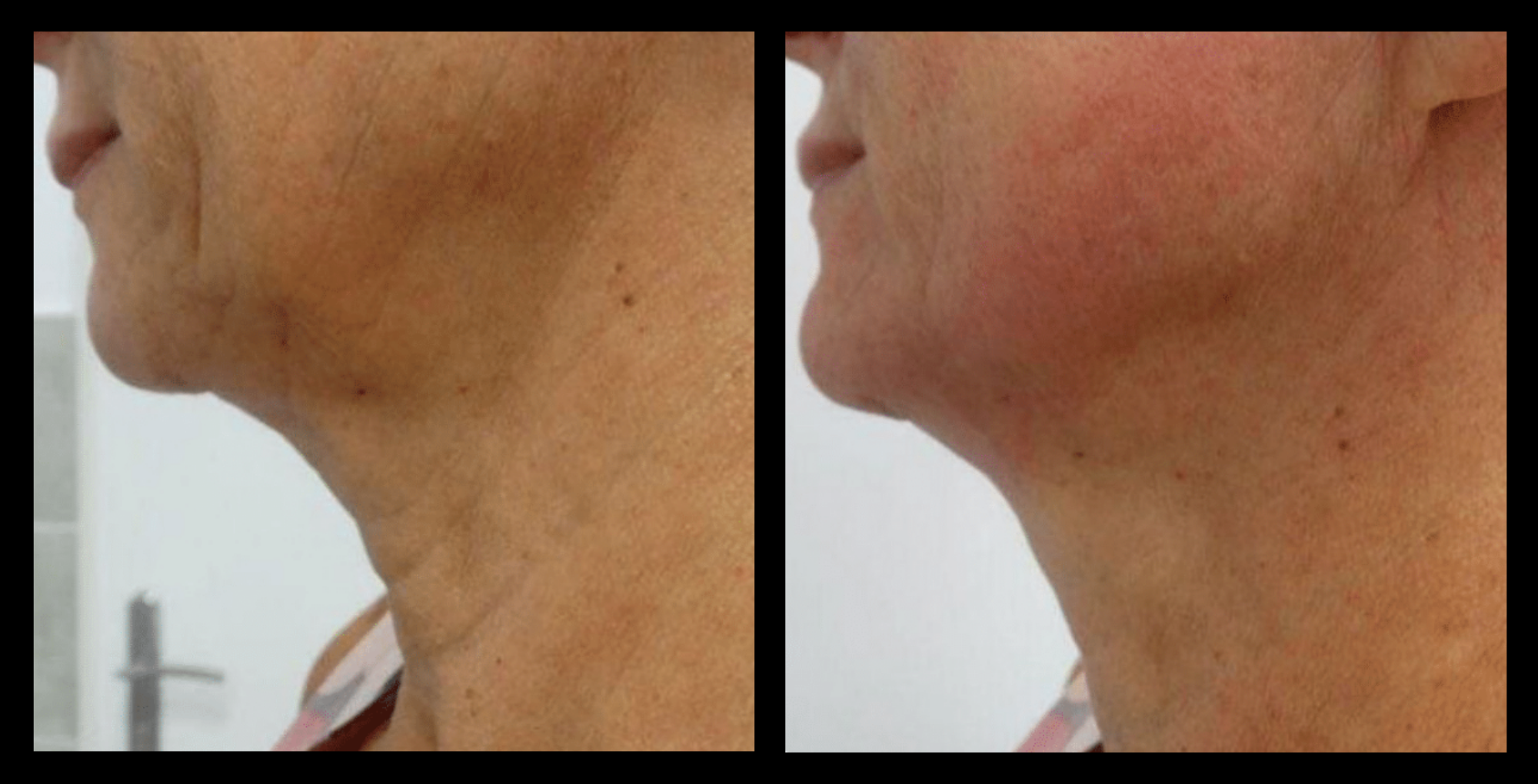 Before and after results of Thuzzle Tetrawave treatment targeting double chin reduction. Visible improvement in jawline contour and skin firmness. Image courtesy of GMV. Ideal for non-invasive fat reduction and skin tightening under the chin.