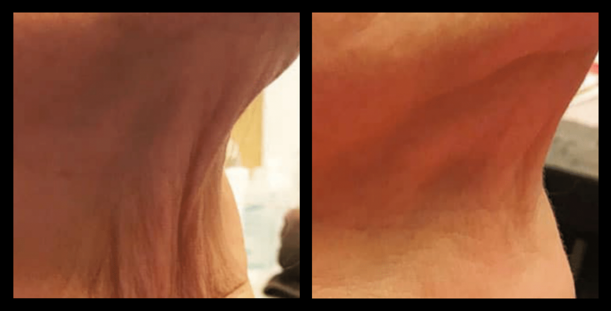 Before and after results of Thuzzle Tetrawave treatment targeting saggy double chin. Noticeable improvement in skin tightening and contour definition after one non-surgical facial rejuvenation session. Photo courtesy of GMV.