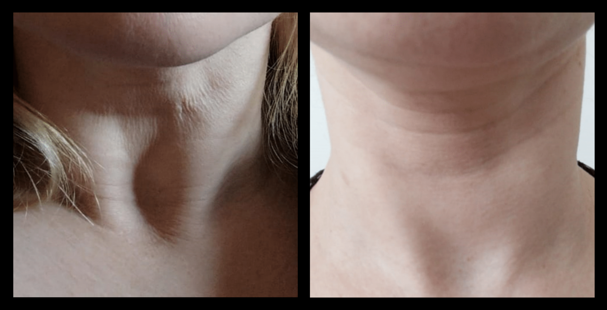 Before and after Thuzzle Tetrawave treatment on saggy neck fat, showing visible skin tightening and contour improvement after one session. Non-invasive neck rejuvenation results. Photo courtesy of GMV, Italy.
