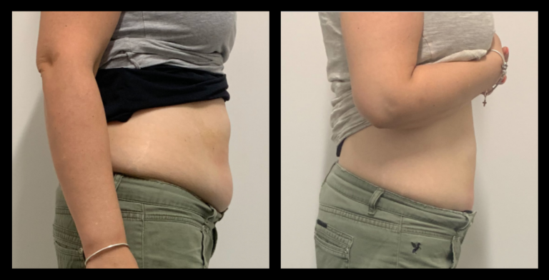 Before and After 3 Ultrasound Body Contouring Treatments – Visible Fat Reduction and Smoother Silhouette by Body Refine, Wollert VIC.