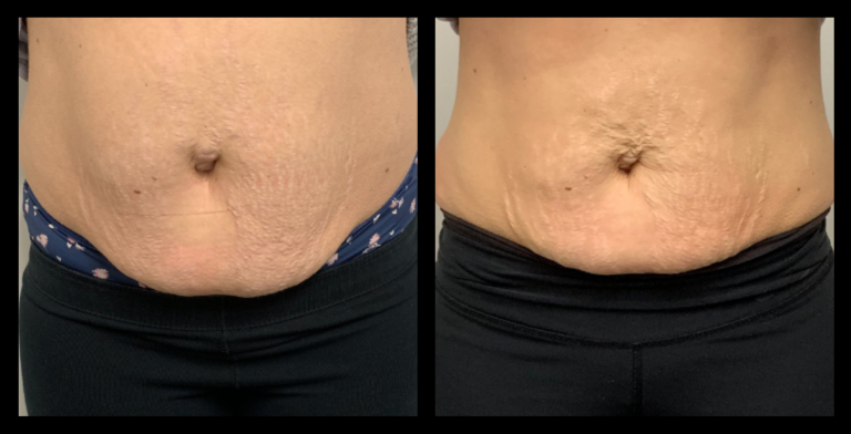 Before and After 4 Ultrasound Body Contouring Treatments – Noticeable Fat Reduction and Body Sculpting Results by Body Refine, Wollert VIC.