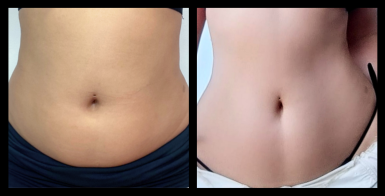 Before and After 8 Ultrasound Body Contouring Treatments – Significant Fat Reduction and Body Sculpting by Iveera, Sydney NSW.