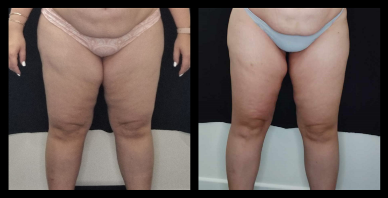 Before and after results of Ultrasound Body Contouring after 12 treatments showing visible fat reduction and improved body shape – courtesy of Body Sculpt Clinic, Maroochydore, QLD.