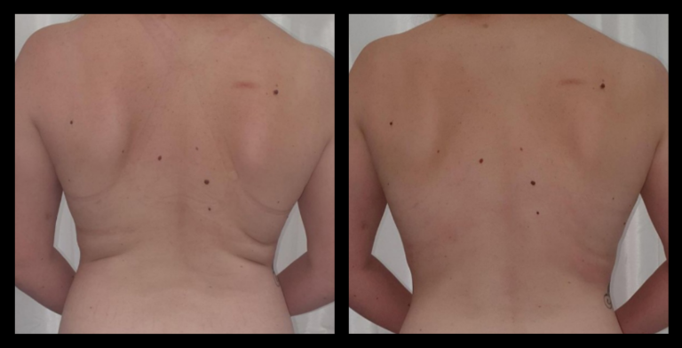 Before and after image of Ultrasound Body Contouring showing visible inch loss and body sculpting results after 1 treatment – courtesy of Le' Marnie Lash & Brow, Lavington, NSW.