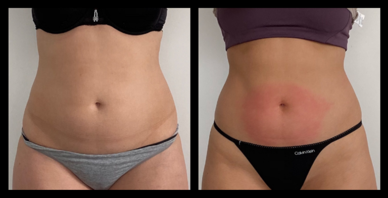 Before and after photo showcasing Ultrasound Body Contouring results after 2 treatments — visible fat reduction and improved body tone. Image courtesy of Body Sculpt Studio Co, South Melbourne, VIC.