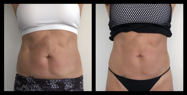 Before and after image showing Ultrasound Body Contouring results after 2 treatments — noticeable fat reduction and smoother body contours. Photo courtesy of Aesthetic Studio Australia, Malvern East, VIC.
