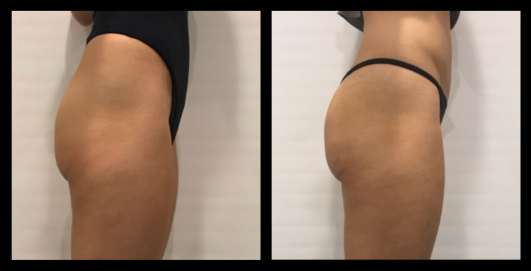 Ultrasound Body Contouring before and after results after 5 treatments, showing visible reduction in body fat and improved skin firmness. Photo courtesy of The Shapeshifters Skin Hair Body, Melbourne, VIC.