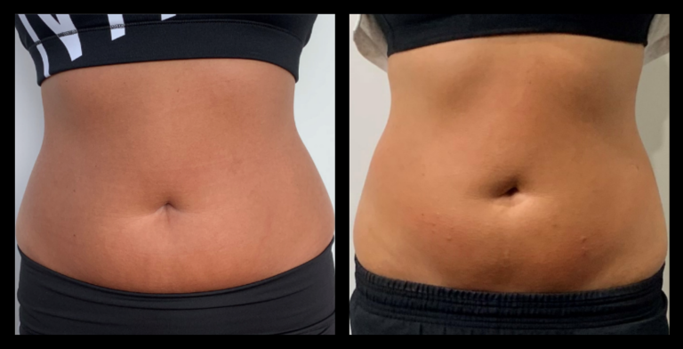 Ultrasound Body Contouring Results After 3 Treatments. Photo courtesy of Shea Michelle Cosmetic Contouring, Box Hill, VIC.