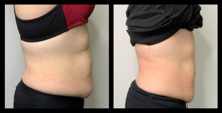 Before and after 2 ultrasound body contouring treatments showing visible fat reduction and body sculpting results – Shea Michelle Cosmetic Contouring, Box Hill VIC.