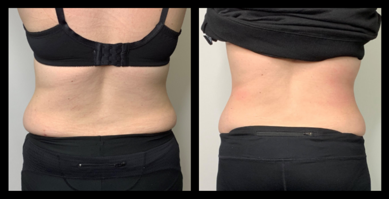 Ultrasound body contouring before and after results after 2 treatments showing visible fat reduction and skin tightening – Shea Michelle Cosmetic Contouring, Box Hill VIC.