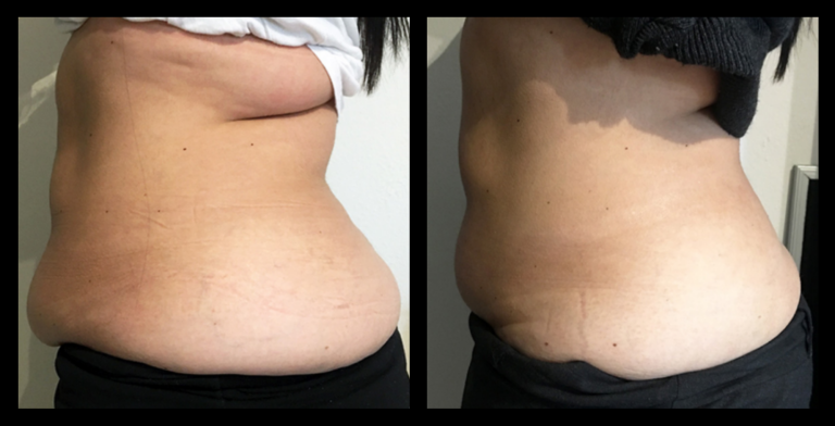 Before and after results of ultrasound body contouring after 4 treatments, showing reduced fat and improved body shape – Glow Skin + Body, Doveton VIC.