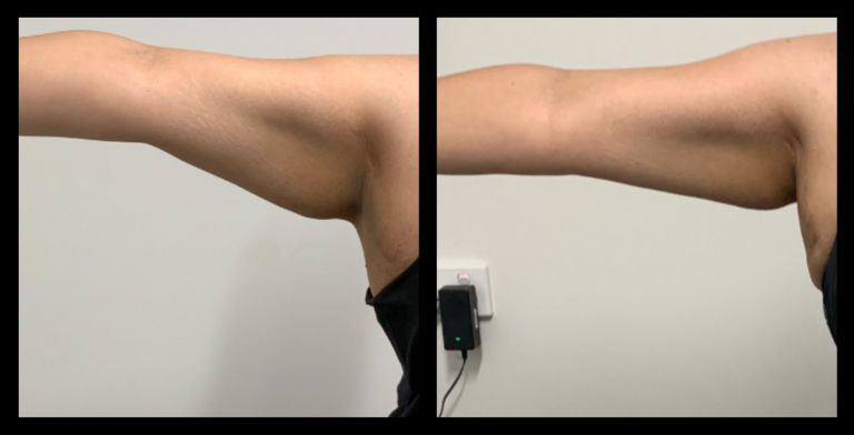 Ultrasound Body Contouring and Radio Frequency Skin Tightening Results After 3 Treatments. Photo courtesy of Body Refine Body Contouring.