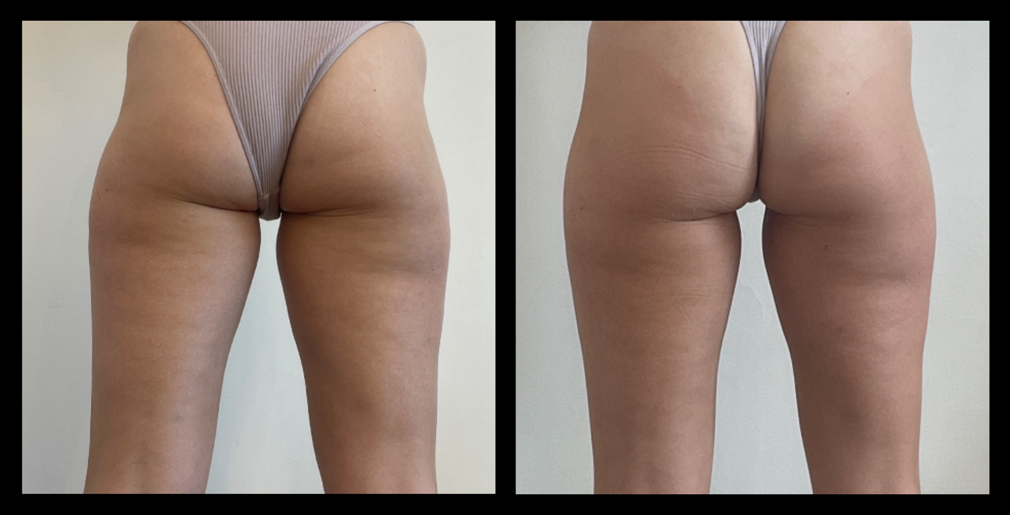 Before and after results showing noticeable improvement in body contour and reduced fat visibility after 4 vascularization and lipolysis treatments. Enhanced tone and circulation achieved at Youthful by Rosie, Brighton, VIC.