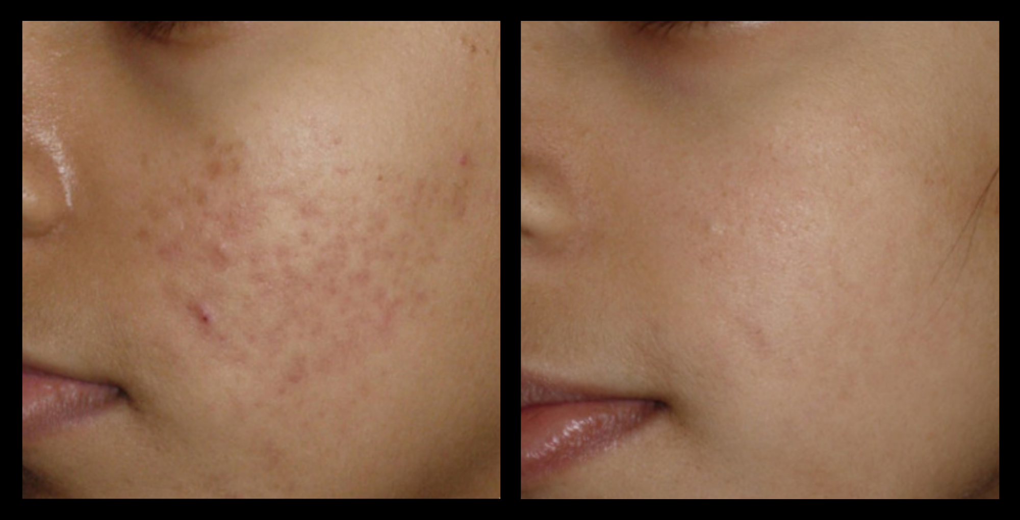 Visible skin improvement on client’s cheeks after XCellaris PRO TWIST microneedling treatment. Smoother texture and enhanced radiance shown. Results courtesy of Dermaroller®. Ideal for fine lines, uneven tone, and skin rejuvenation.