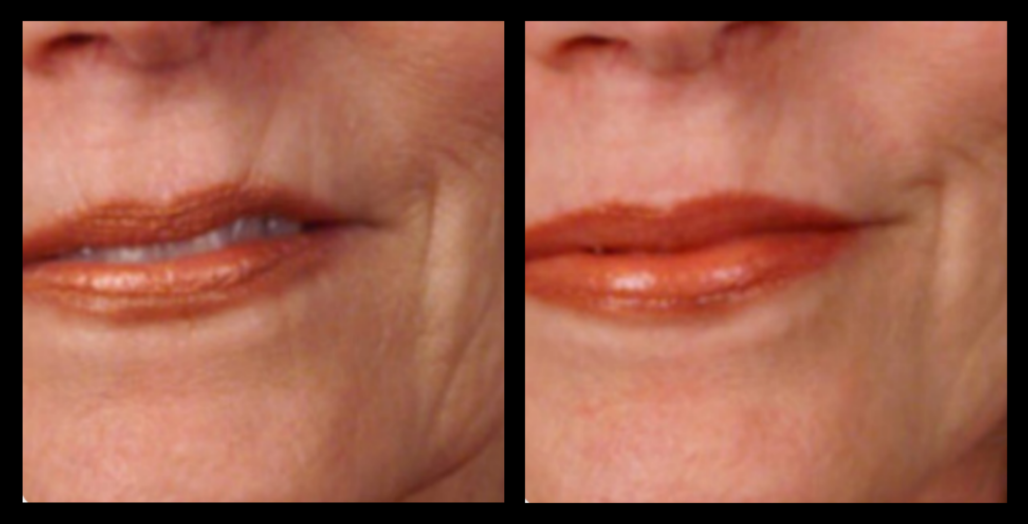 XCellaris PRO TWIST microneedling treatment results shown after one session. Noticeable improvement in skin texture, firmness, and tone. Treatment performed using advanced Dermaroller® technology—ideal for professional skin rejuvenation and collagen stimulation.