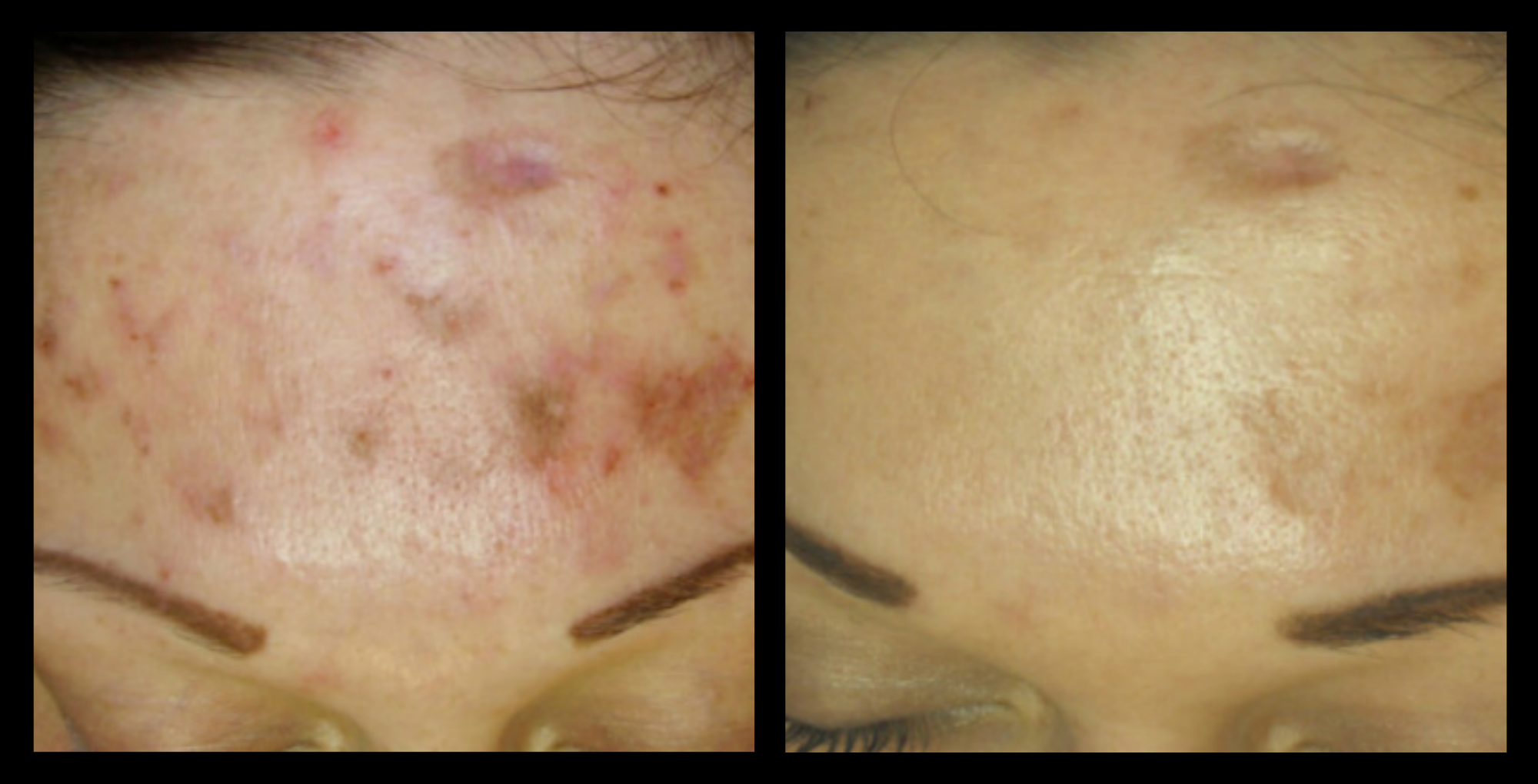 XCellaris PRO TWIST microneedling results showing refined skin texture and visibly smoother, rejuvenated appearance. Professional-grade treatment using Dermaroller® technology—ideal for boosting collagen, improving skin tone, and enhancing overall facial radiance.