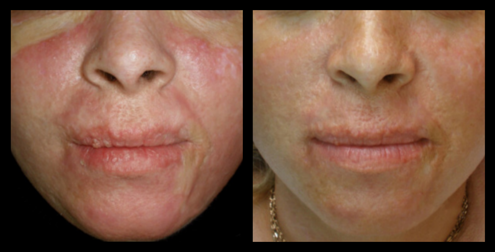 XCellaris PRO TWIST microneedling results highlighting visibly smoother skin and improved tone. Advanced skin rejuvenation using Dermaroller® technology—ideal for reducing fine lines, refining texture, and enhancing overall skin clarity.
