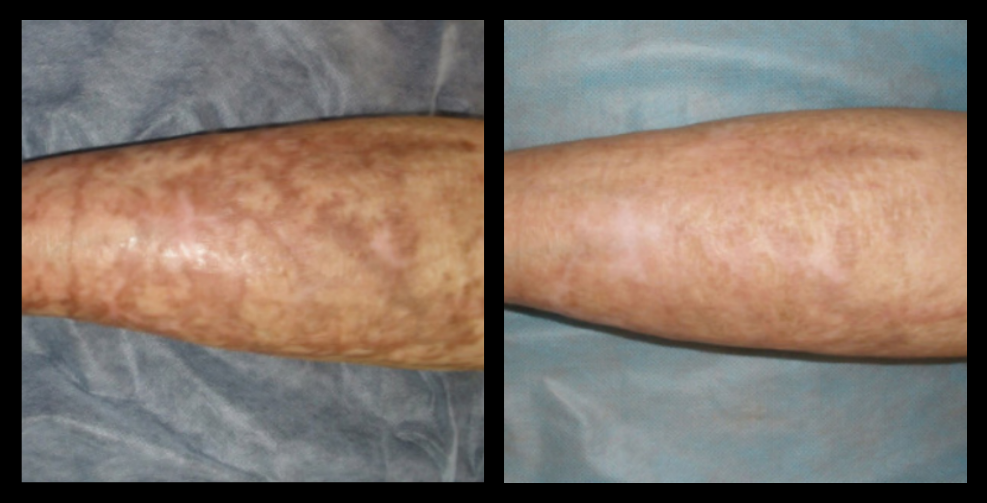 XCellaris PRO TWIST microneedling results on client's arms showing visibly smoother, firmer skin. Professional Dermaroller® technology used to improve skin texture, boost collagen, and reduce the appearance of roughness and uneven tone.
